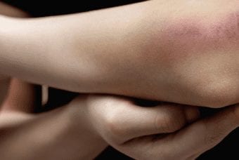 Woman bruised arm