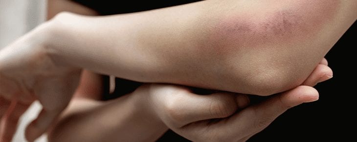 Woman bruised arm